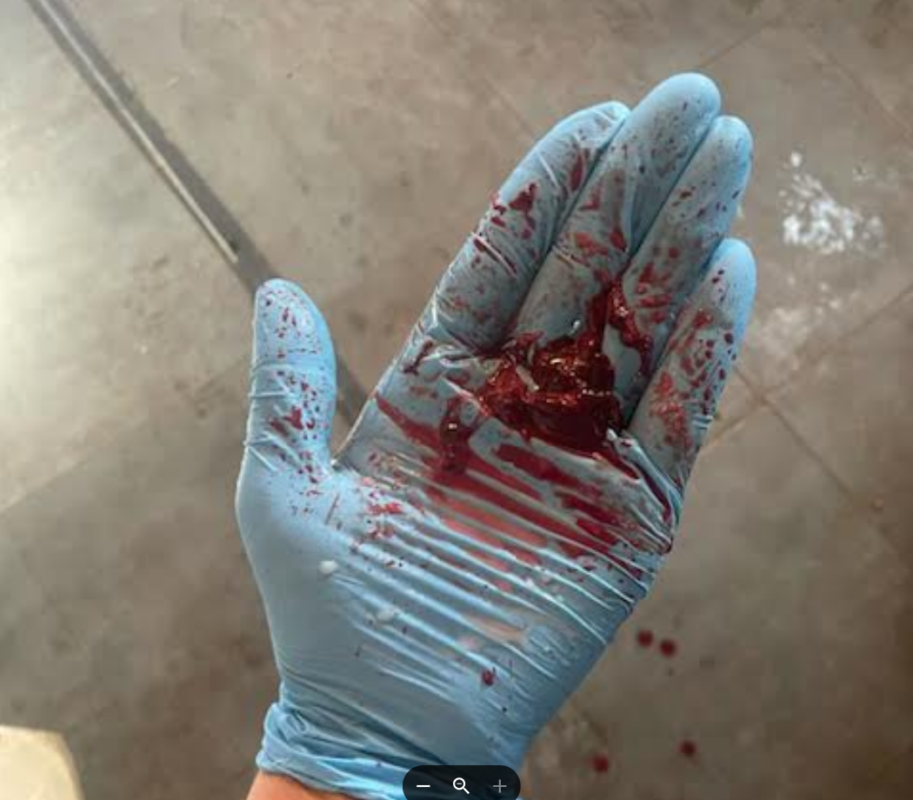 Bloody milk collected from one quarter of a family milk cow